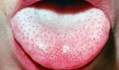 Сыпь на языке губе под языком