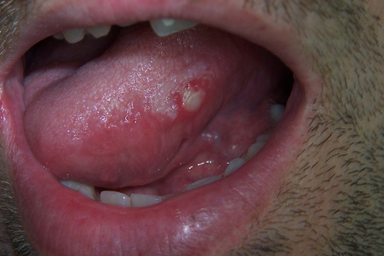 Сыпь на языке губе под языком
