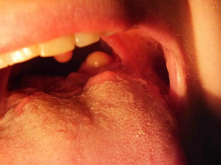 Сыпь на корне языка сухость в горле