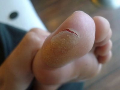 Лечение волдырей на голенях ног thumbnail