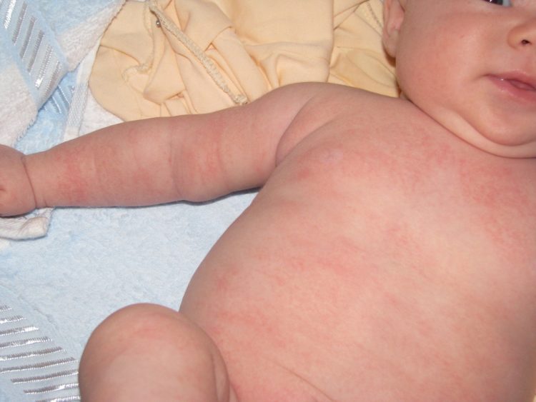 Сыпь по типу крапивницы температура у детей