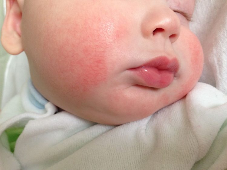 Сыпь у ребенка на лице после сна