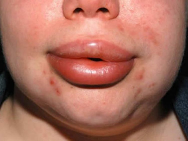 Аллергическая крапивница: что такое аллергическая сыпь фото, причины возниконовения крапивницы на коже, как ее лечить и чем, а также диета что можно есть