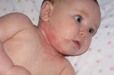 Сыпь у ребенка на лице после сна