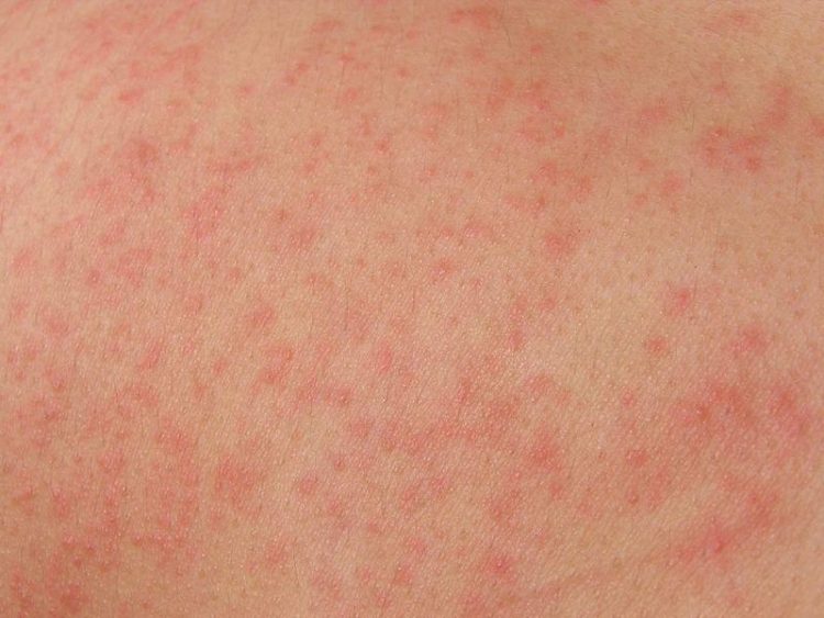 Аллергия у ребенка как ожоги от крапивы thumbnail