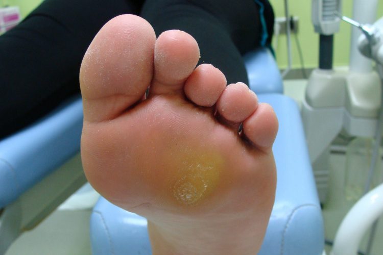 Мозоли на ступнях ног фото и лечение