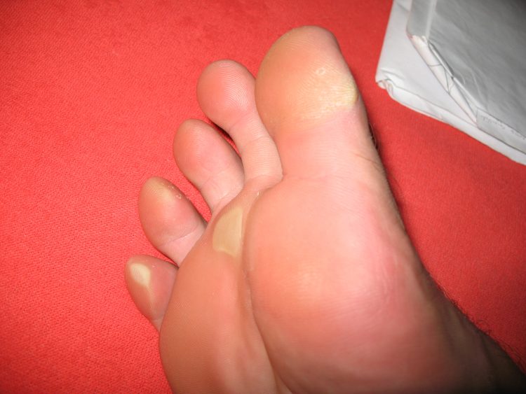 Шишки от мозолей на пальцах ног причины и лечение thumbnail