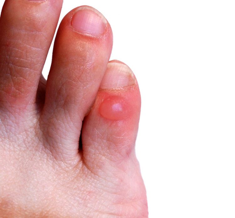 Шишки от мозолей на пальцах ног причины и лечение
