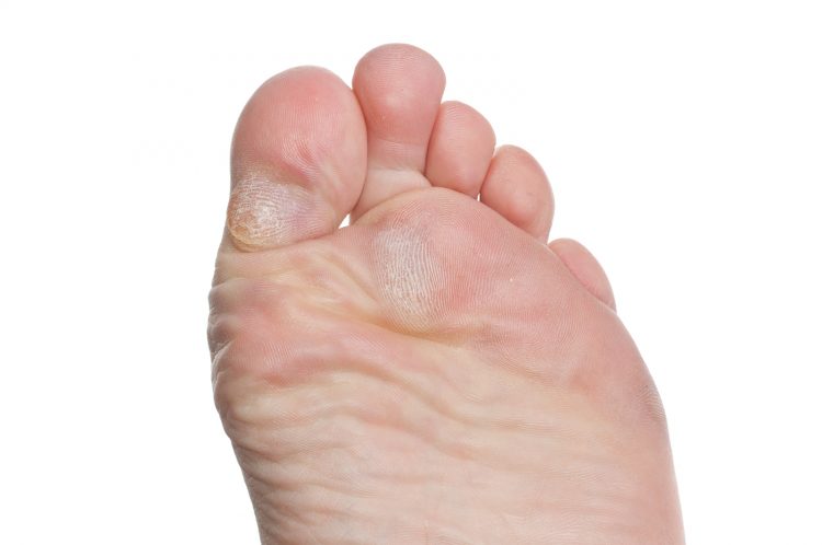 Мозоль на пальце ноги на большом пальце ноги лечение thumbnail