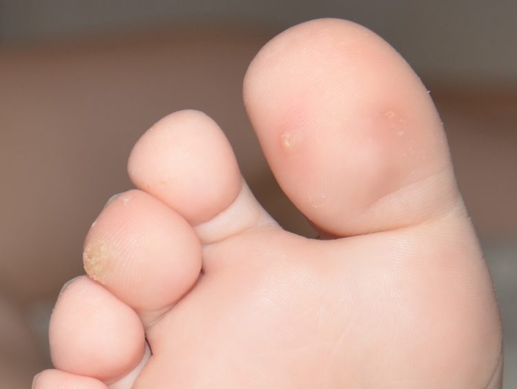 Мозоль на большом пальце ноги причина thumbnail
